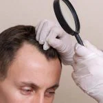مراحل و نحوه انجام کاشت مو به روش sut
