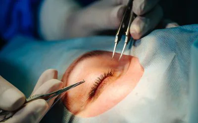Permanent eyelash implantation5