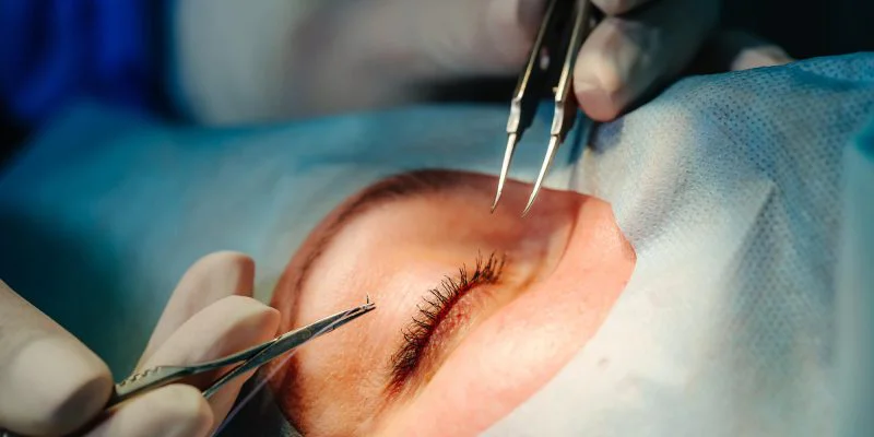 Permanent eyelash implantation5