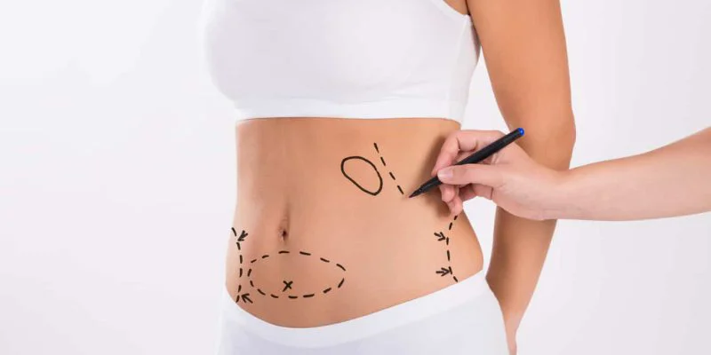 liposuction-markings